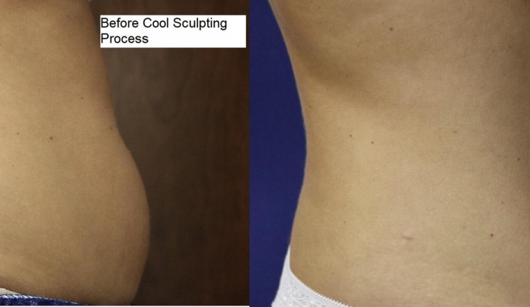 58-year-old American Undergoes Fat Reduction Procedure Post-Cancer Battle