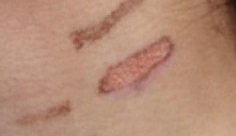 First-Degree Laser Burns Can Take Around a Year or Two to Heal