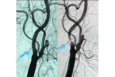 Interventional Cardiologist successfully performs a rare Carotid Stent