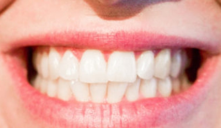 Tooth Bonding In Abu Dhabi | Emirates Royal Center