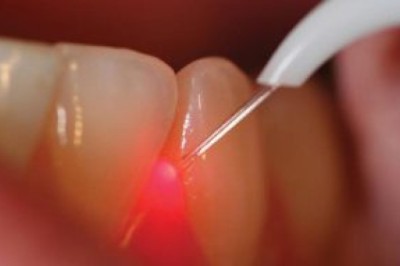 Root Canal Treatment In Abu Dhabi | Emirates Royal Center