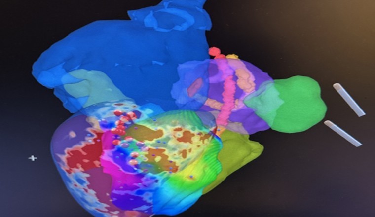 أول عملية استئصال عضلة القلب البطينية الإقفارية البشرية بنجاح في iCMR